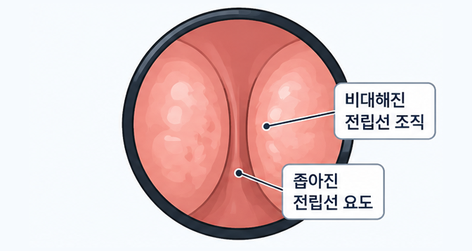 리줌 시술 2단계 — 전립선 비대 부위 확인